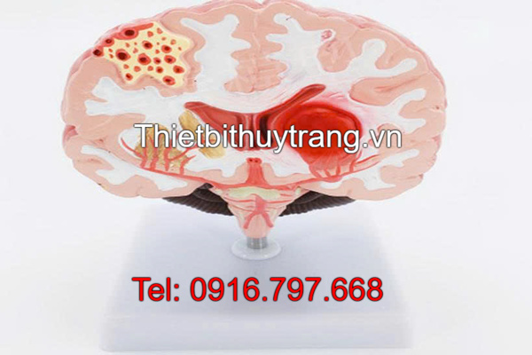Mô Hình Đột Quỵ Não TTV36