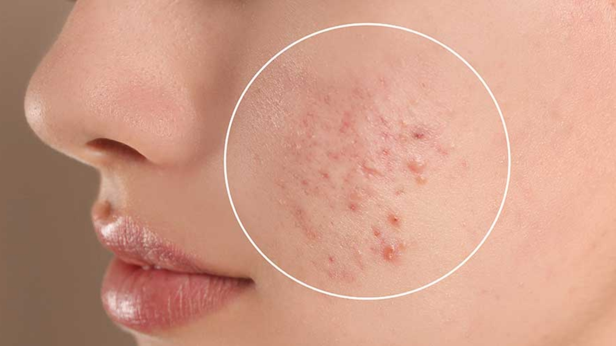 Hỗ trợ giảm viêm và chăm sóc da sau mụn