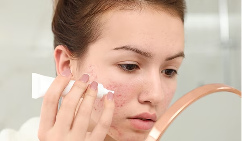 Hướng dẫn dùng kem trị mụn Nhật Bản hiệu quả