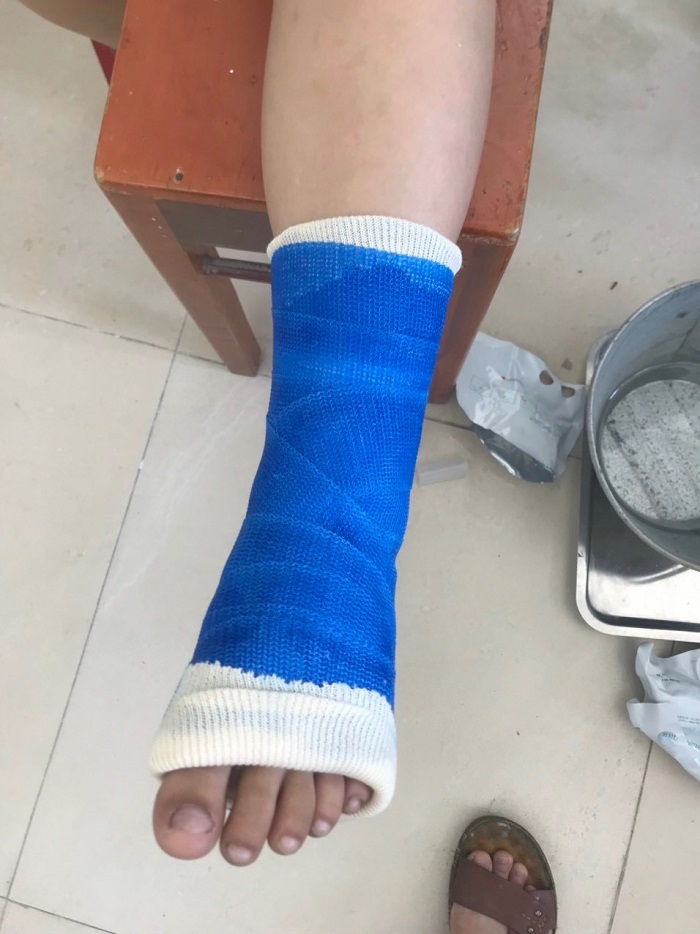 hình ảnh bệnh nhân sử dụng bột bó thủy tinh Tomato