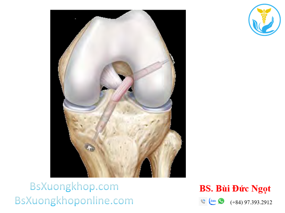 Phẫu thuật tái tạo dây chằng chéo trước | BSXuongkhop.com