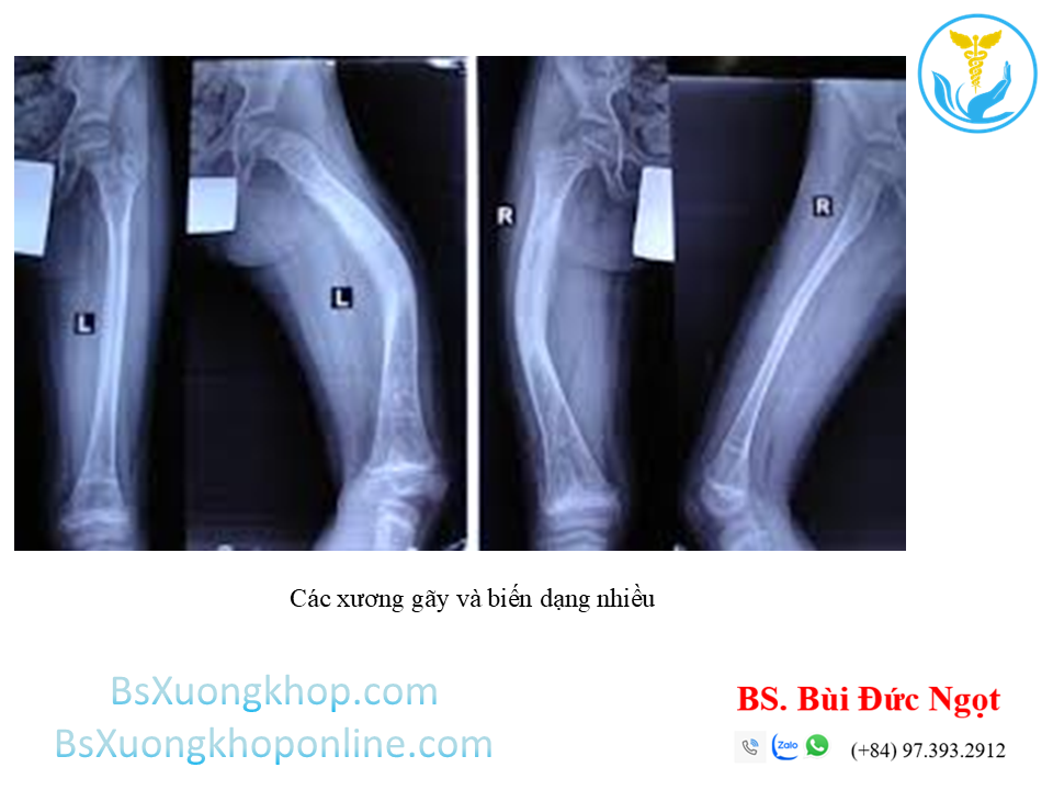 Bệnh xương bất toàn khiến xương bị biến dạng ||| BsXuongkhop.com