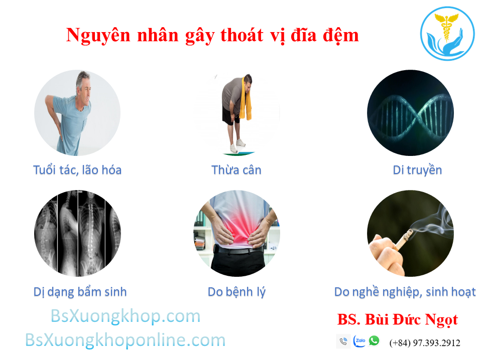 Nguyên nhân thoát vị đĩa đệm