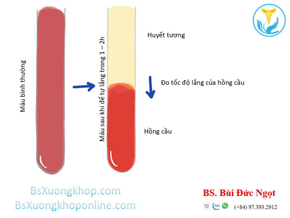 Xét nghiệm máu lắng ||| BSXuongkhop.com