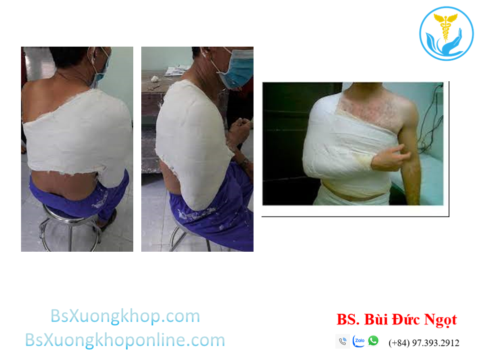 Bột ngực vai cánh tay | BsXuongkhop.com