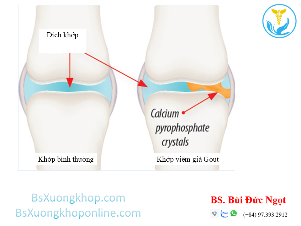 Giả Gout ||| BsXuongkhop.com