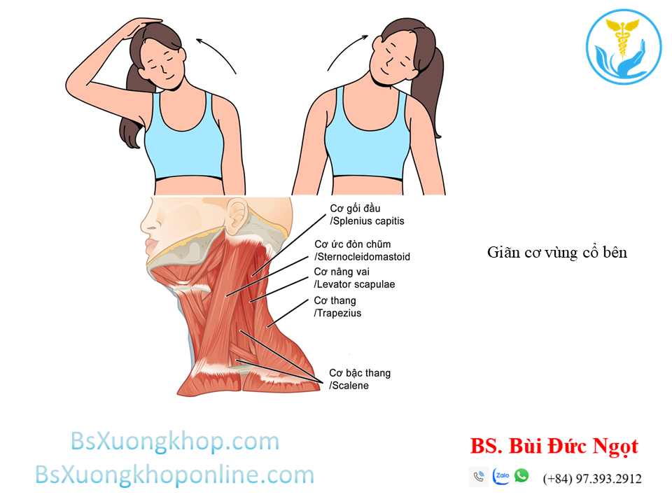 BT giãn cơ vùng cổ bên ||| BsXuongkhop.com