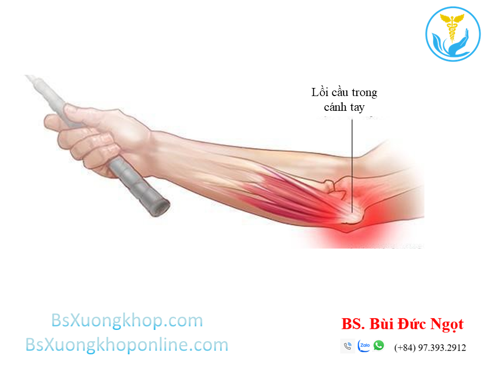 Bệnh lý Golfer Elbow | BsXuongkhop.com