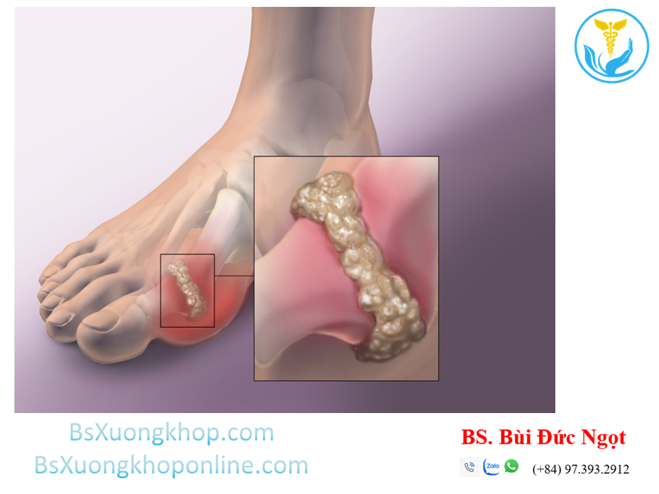 Bệnh thống phong (Gout - Gút) ||| BsXuongkhop.com