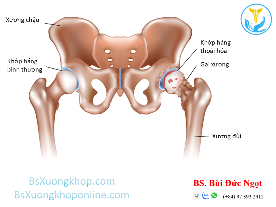 Thoái hóa khớp háng ||| BsXuongkhop.com
