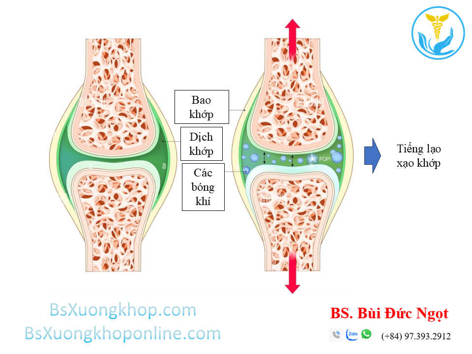 Tiếng lạo xạo khớp ||| BsXuongkhop.com