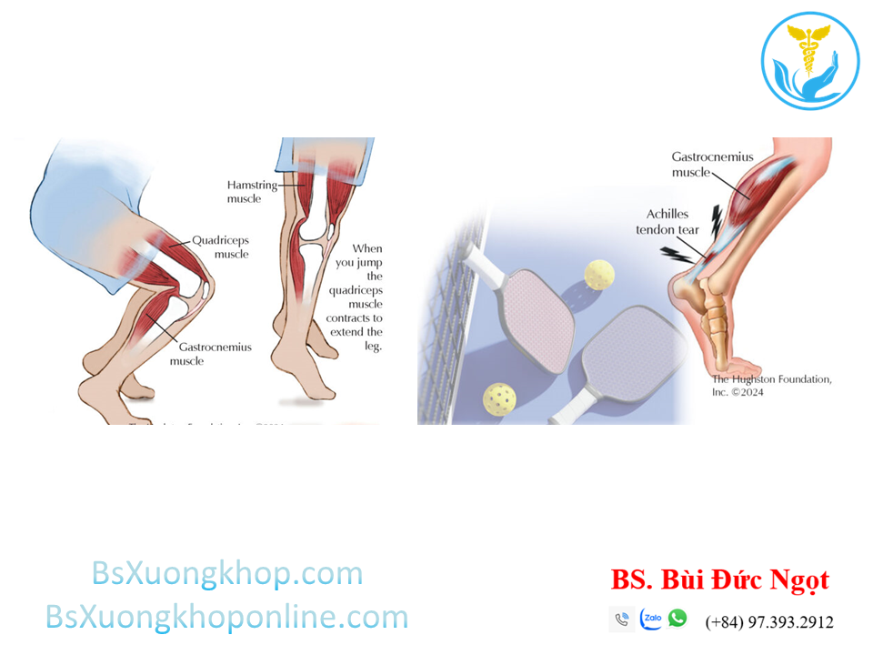 Chấn thương thường gặp khi chơi thể thao trong mùa lạnh | BsXuongkhop.com