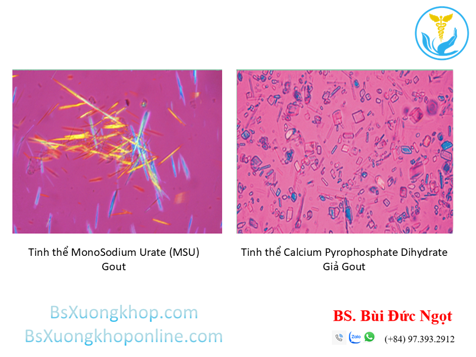 Bệnh lắng đọng tinh thể Canxi Pyrophosphate (CPPD) là gì? Nguyên nhân & Điều trị ||| BsXuongkhop.com