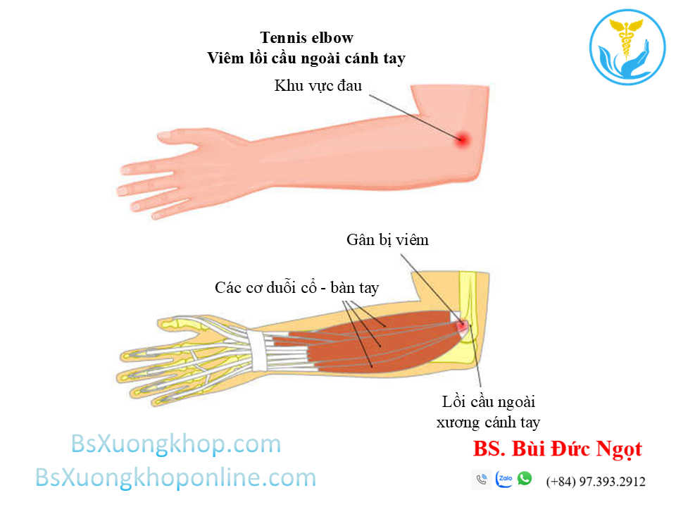 Bệnh lý tennis Elbow | BsXuongkhop.com