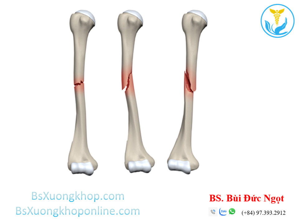 Gãy thân xương cánh tay | BsXuongkhop.com