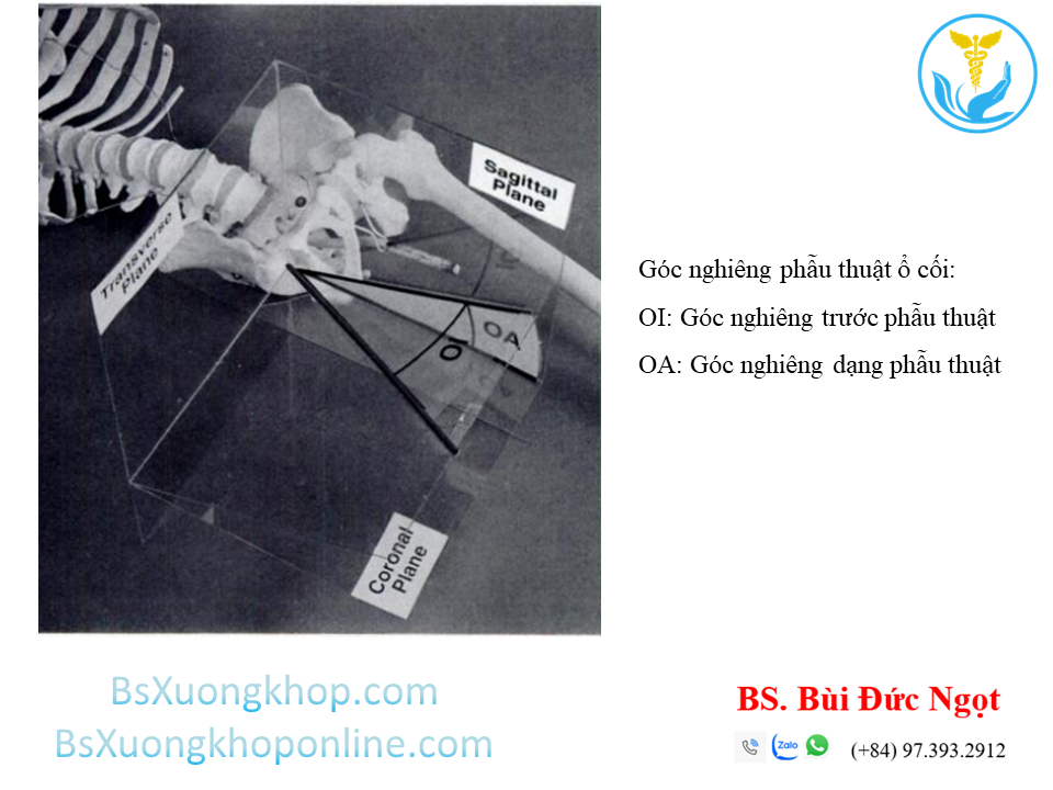 Định nghĩa phẫu thuật về 2 góc nghiêng của ổ cối