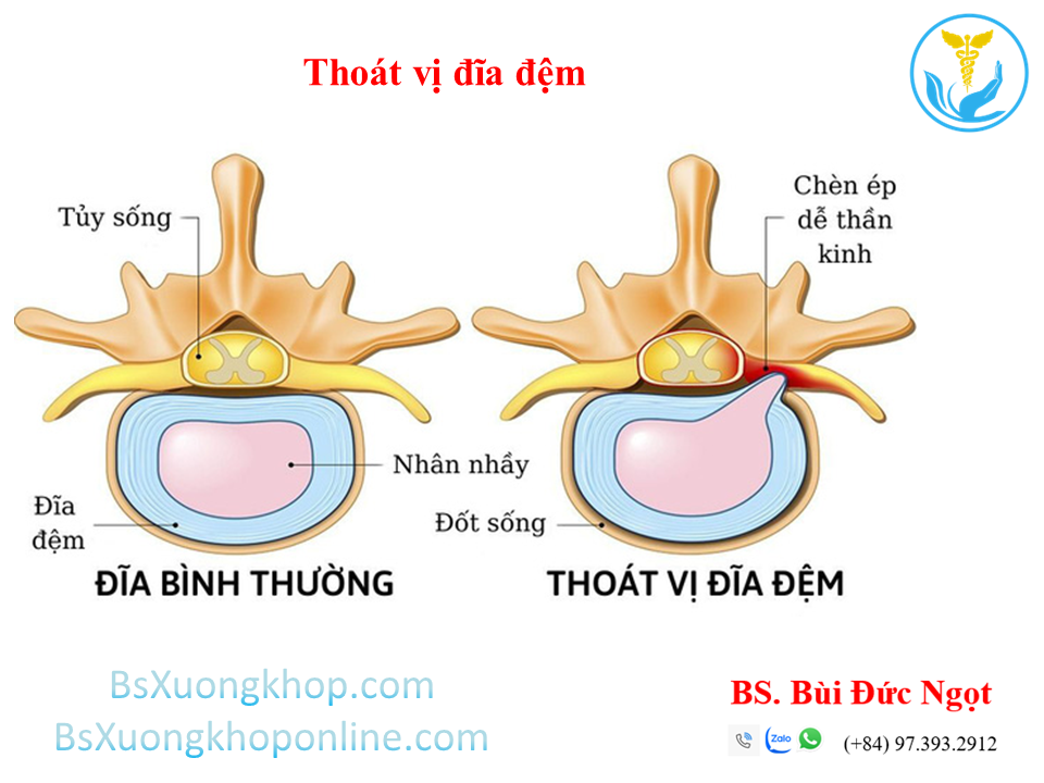 Thoát vị đĩa đệm là gì