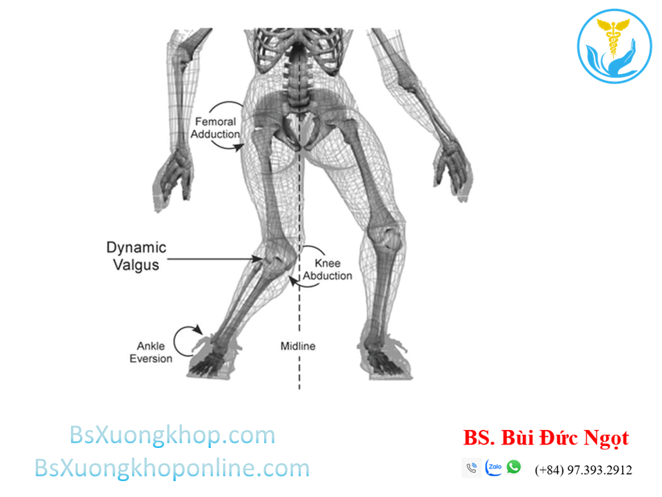 Cơ chế chấn thương dây chằng chéo trước