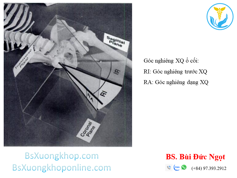 Định nghĩa của chẩn đoán hình ảnh (XQ) về 2 góc nghiêng của ổ cối