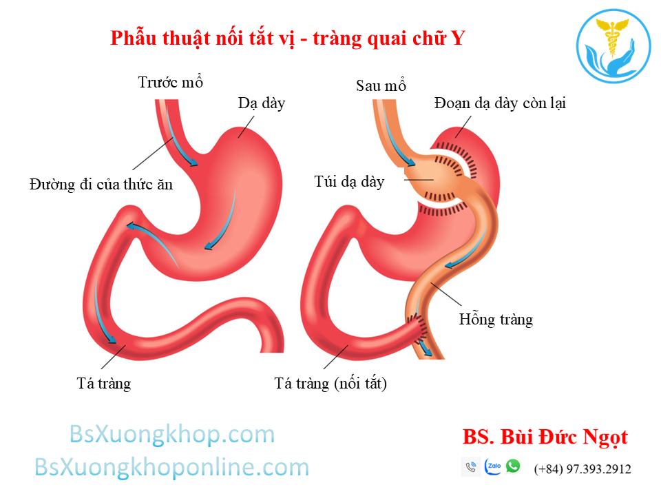 Phẫu thuật Giảm cân là gì? Các kiến thức cơ bản ||| BsXuongkhop.com
