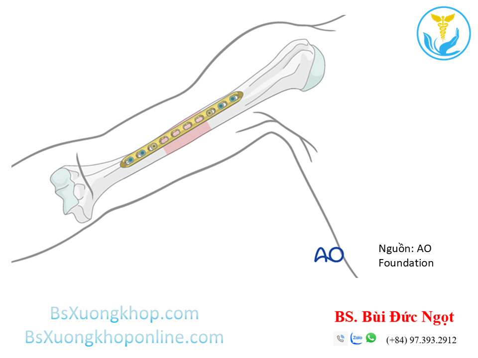 Nẹp vis xương cánh tay | BsXuongkhop.com