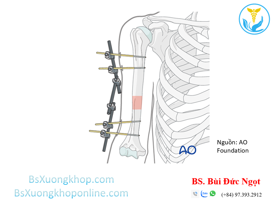 Khung cố định ngoại vi xương cánh tay | BsXuongkhop.com