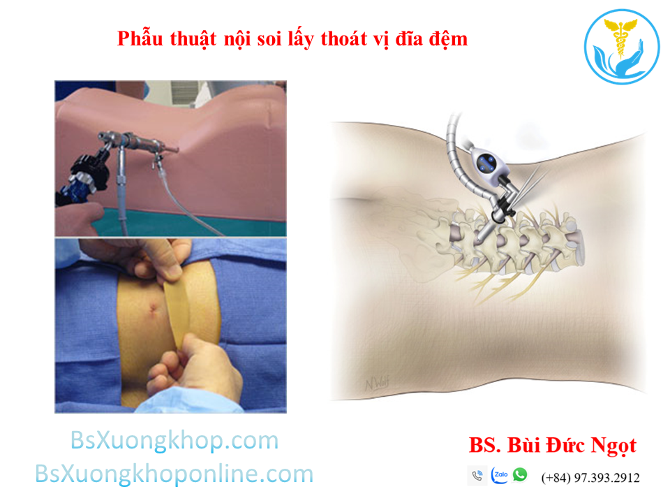 Phẫu thuật nội soi cột sống thắt lưng lấy thoát vị