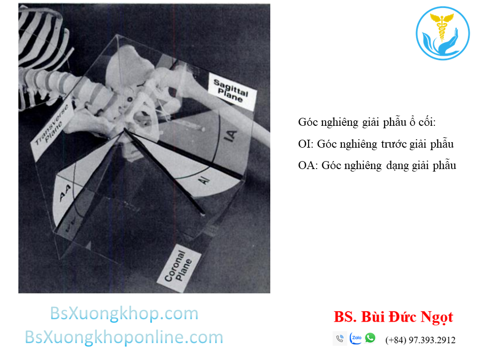 Định nghĩa giải phẫu về 2 góc nghiêng của ổ cối