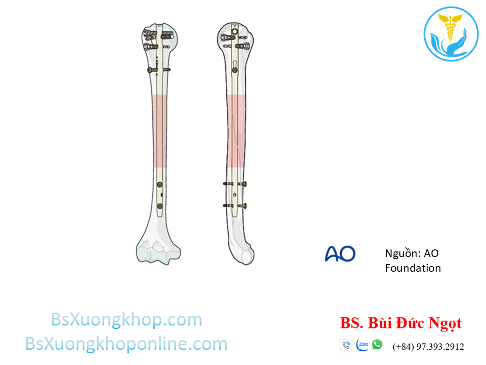 Đinh nội tủy xương cánh tay | BsXuongkhop.com