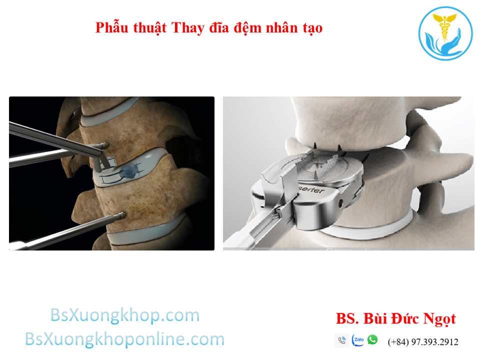 Phẫu thuật thay đĩa đệm nhân tạo