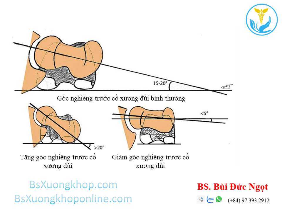 Góc nghiêng trước cổ xương đùi