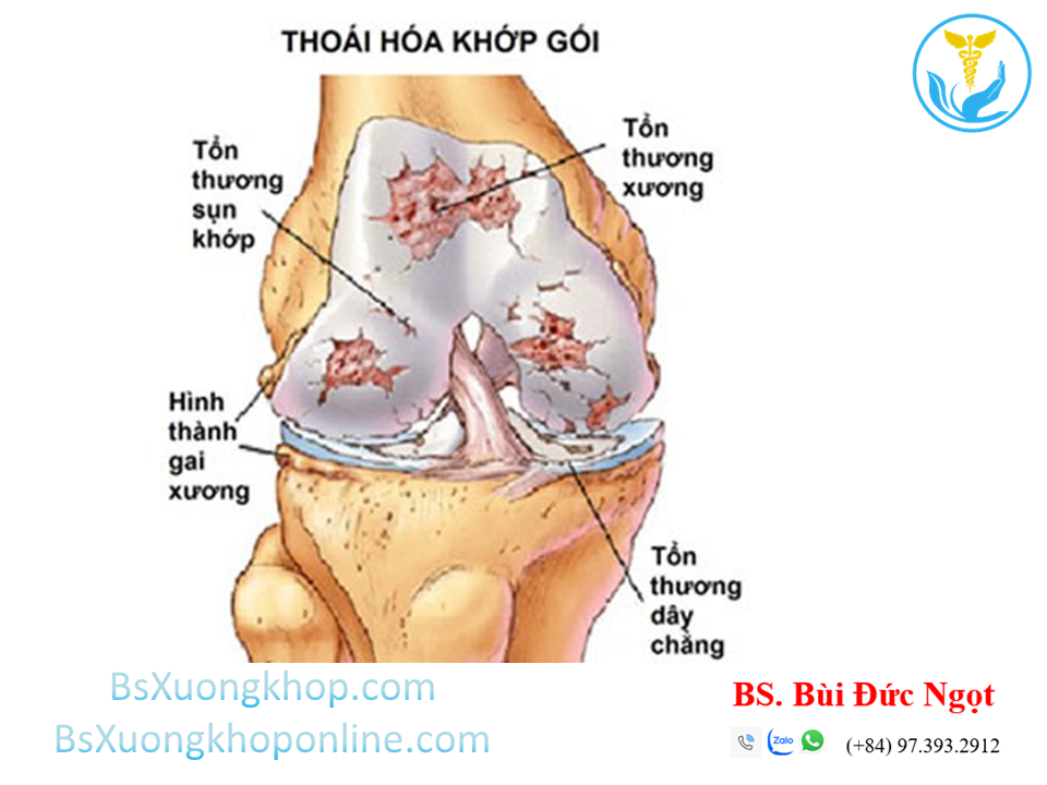 Thoái hóa khớp gối ||| BsXuongkhop.om
