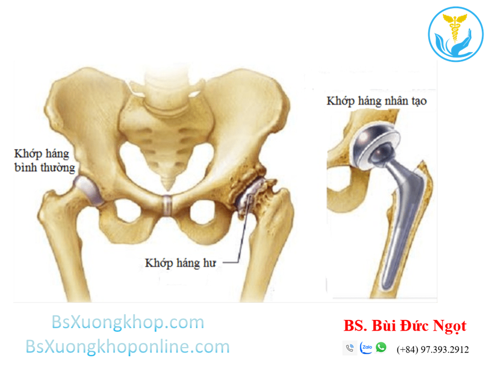 Thoái hóa khớp háng là gì ||| BsXuongkhop.com