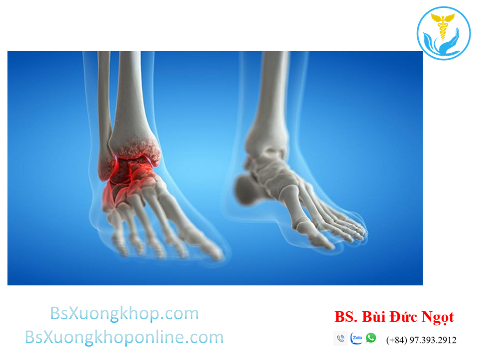 Thoái hóa khớp cổ chân ||| BsXuongkhop.com