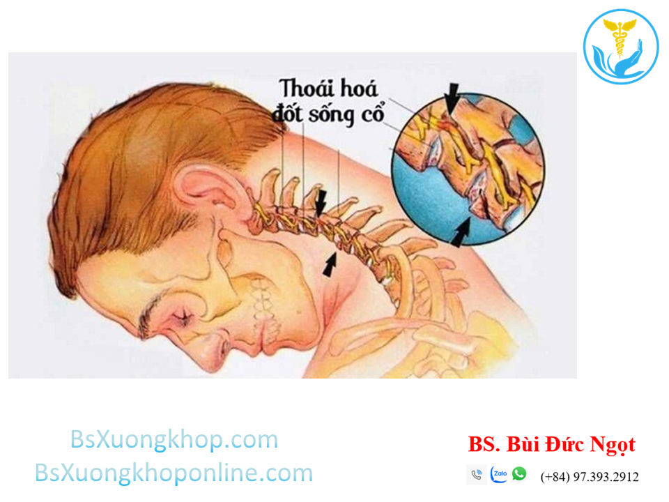 Thoái hóa cột sống cổ là gì? ||| BsXuongkhop.com