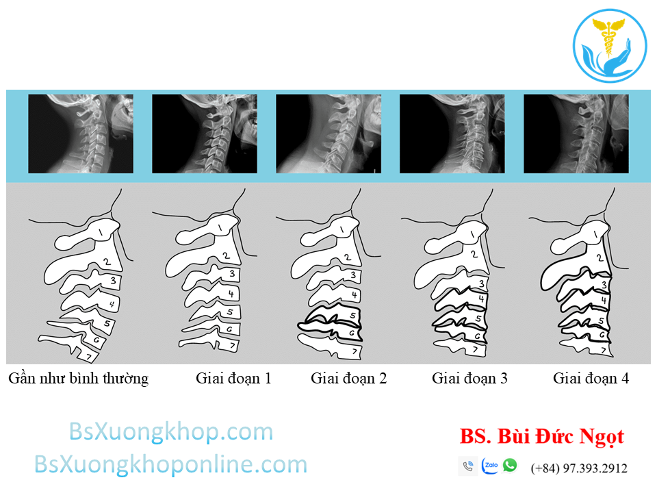 Thoái hóa cột sống cổ là gì? ||| Bsxuongkhop.com