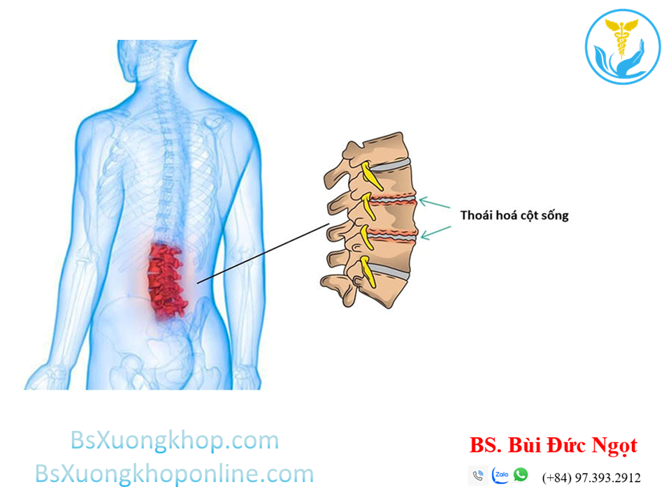 Thoái hóa cột sống thắt lưng là gì? ||| BsXuongkhop.com