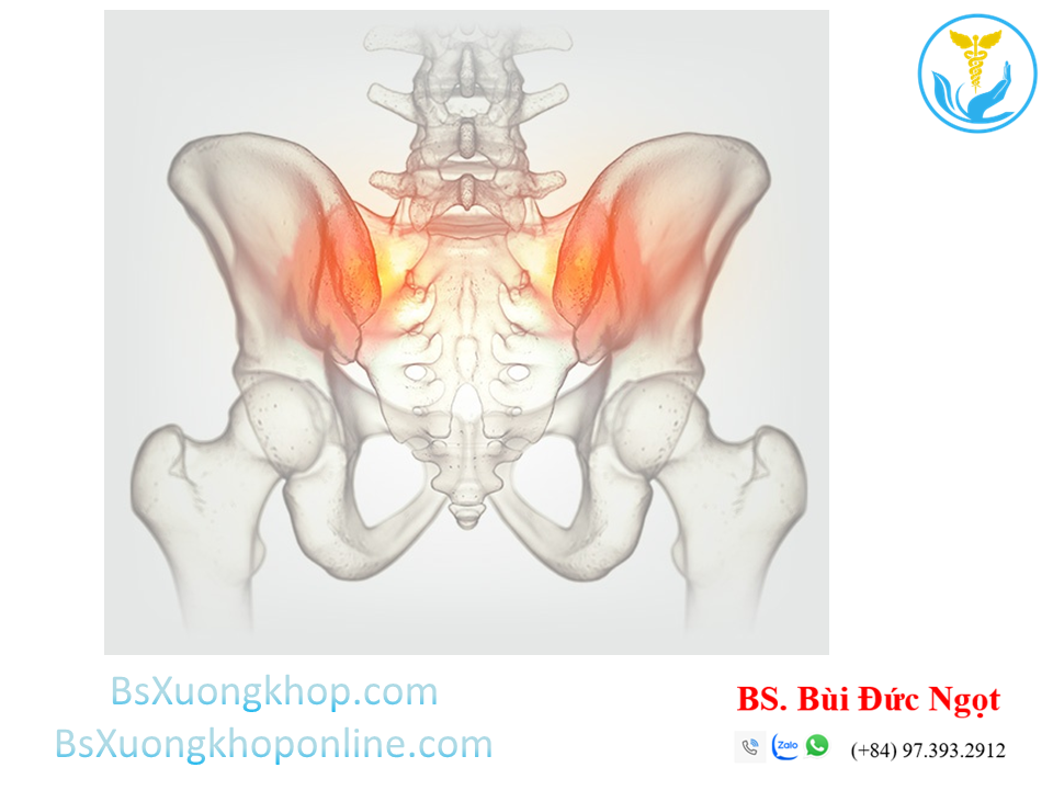 Thoái hóa khớp cùng chậu là gì? |||BsXuongkhop.com