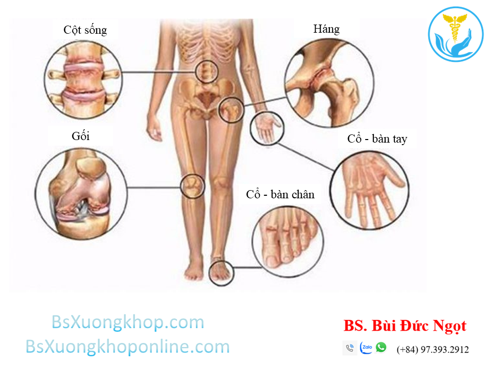 Thoái hóa đa khớp ||| BsXuongkhop.com