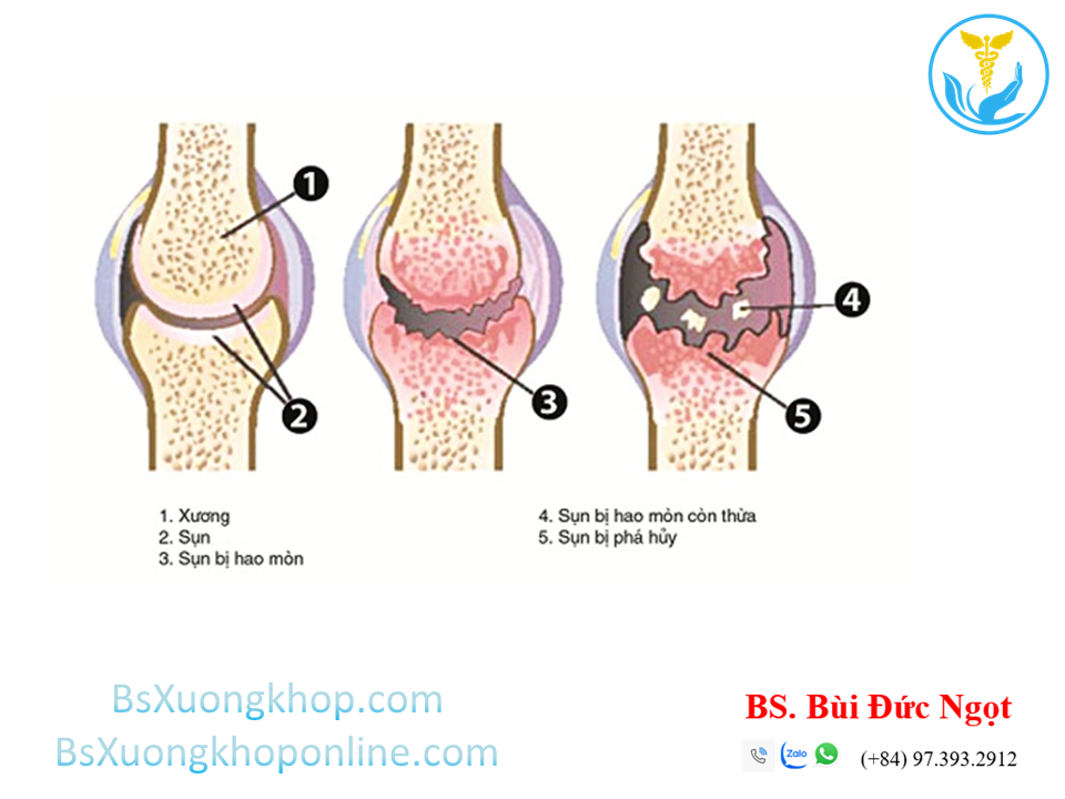 Thoái hóa khớp nguyên phát ||| BsXuongkhop.com