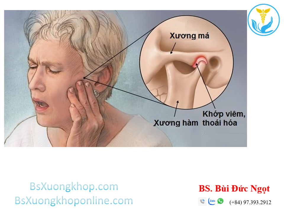 thoái hóa khớp thái dương hàm ||| BsXuongkhop.com