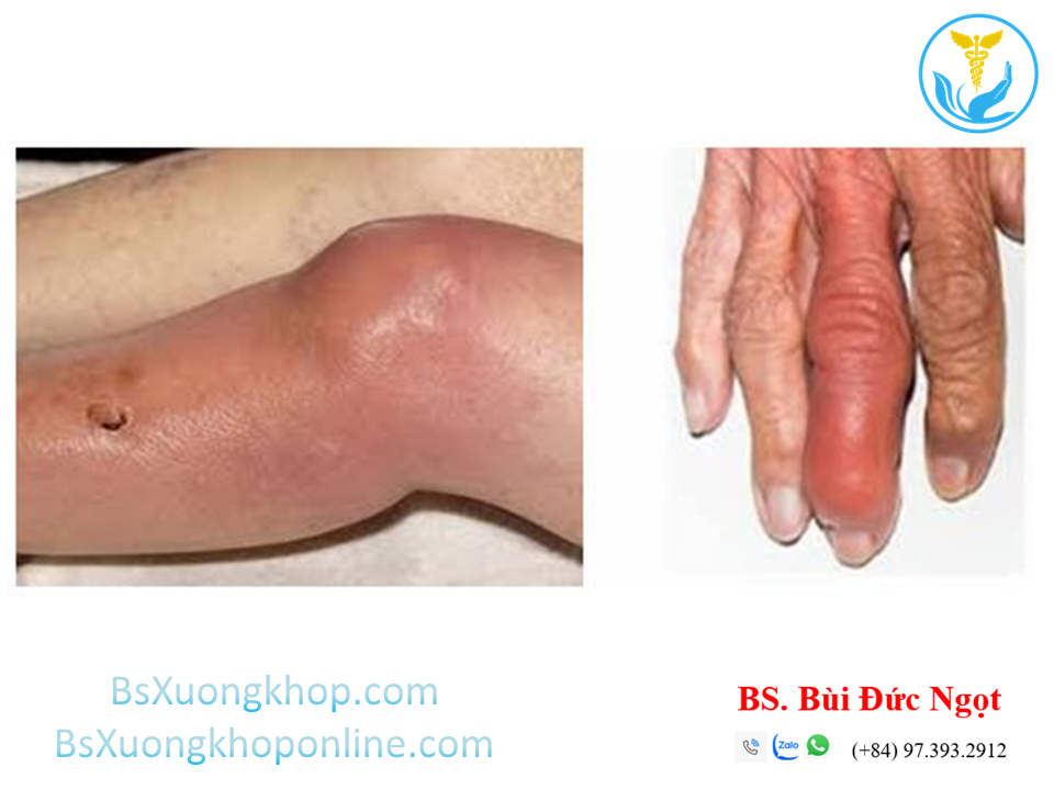 Thoái hóa khớp do nhiễm trùng ||| BsXuongkhop.com