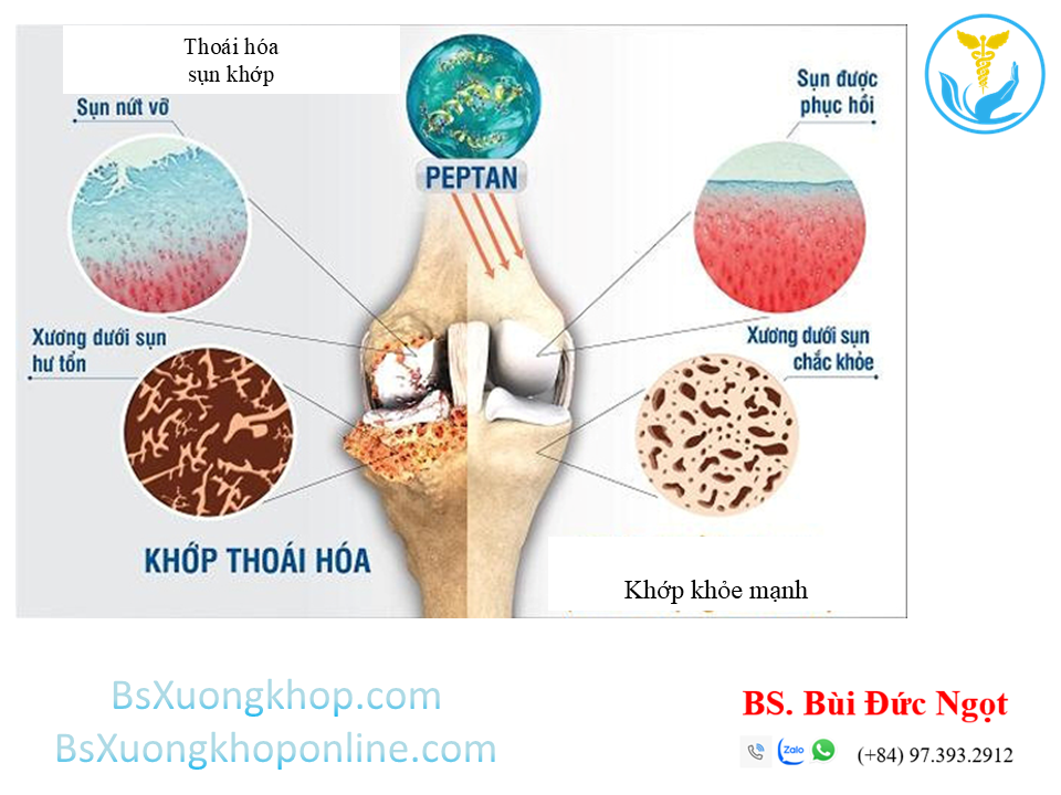 thoái hóa sụn khớp ||| BsXuongkhop.com
