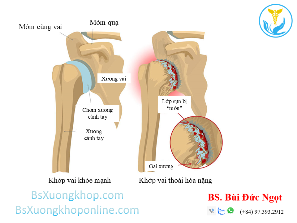 thoái hóa khớp vai ||| BsXuongkhop.com