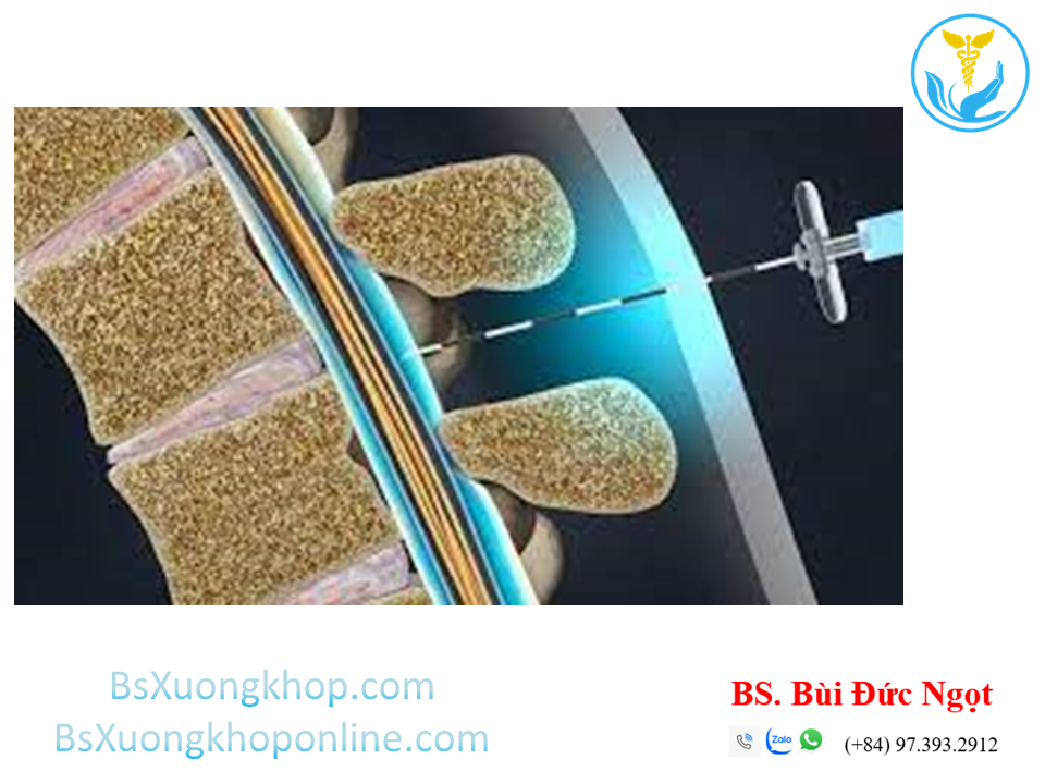 Tiêm ngoài màng cứng ||| BsXuongkhop.com