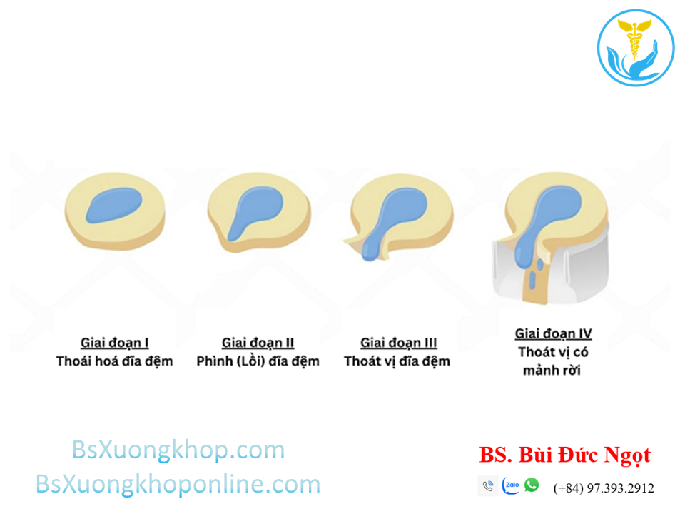 Thoái hóa đĩa đệm là gì ||| BsXuongkhop.com
