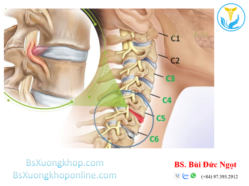 Thoát vị đĩa đệm cột sống cổ là gì? Nguyên nhân & điều trị ||| BsXuongkhop.com