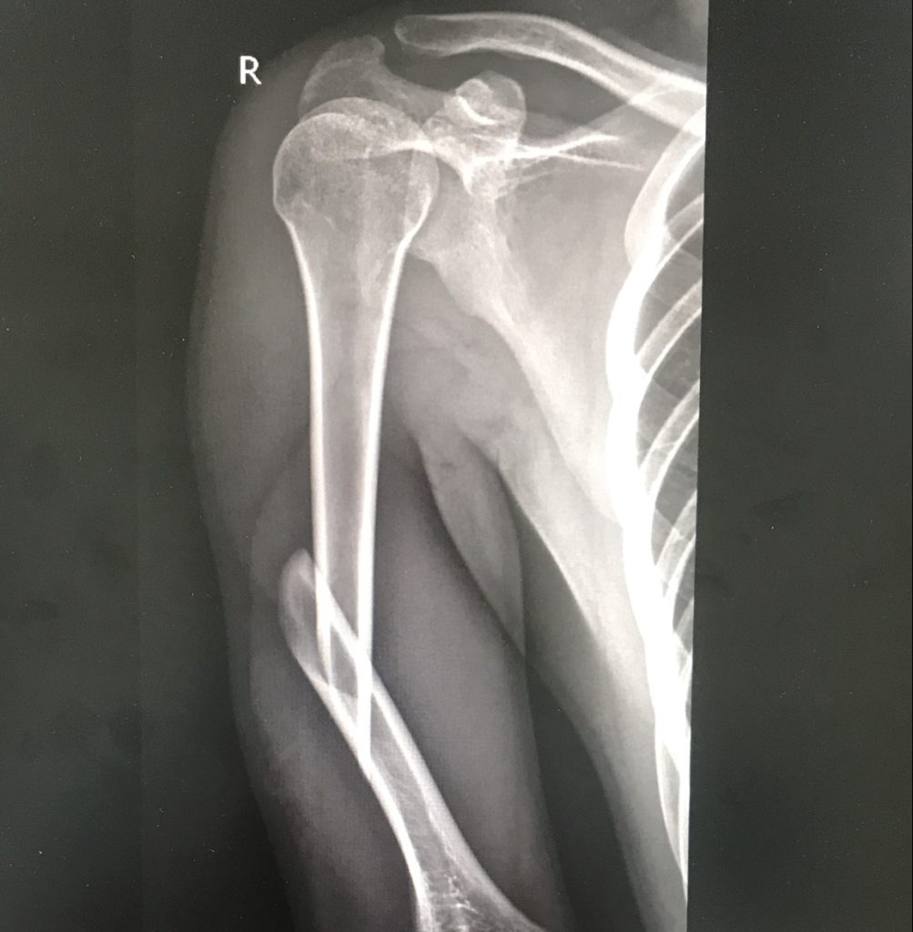 XQ thân xương cánh tay | BsXuongkhop.com