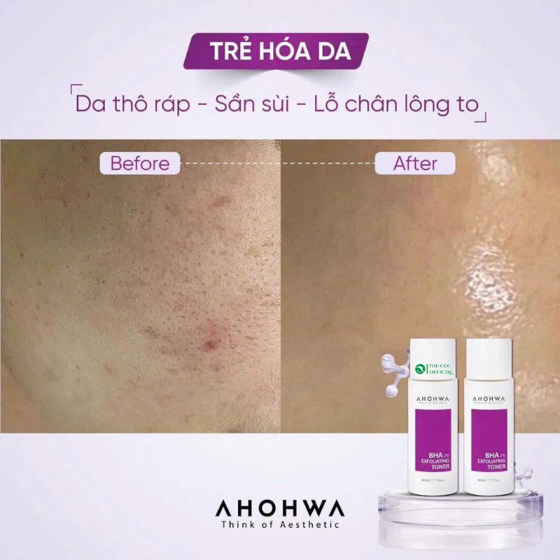 BHA giảm mụn ẩn, mụn bã nhờn hiệu quả