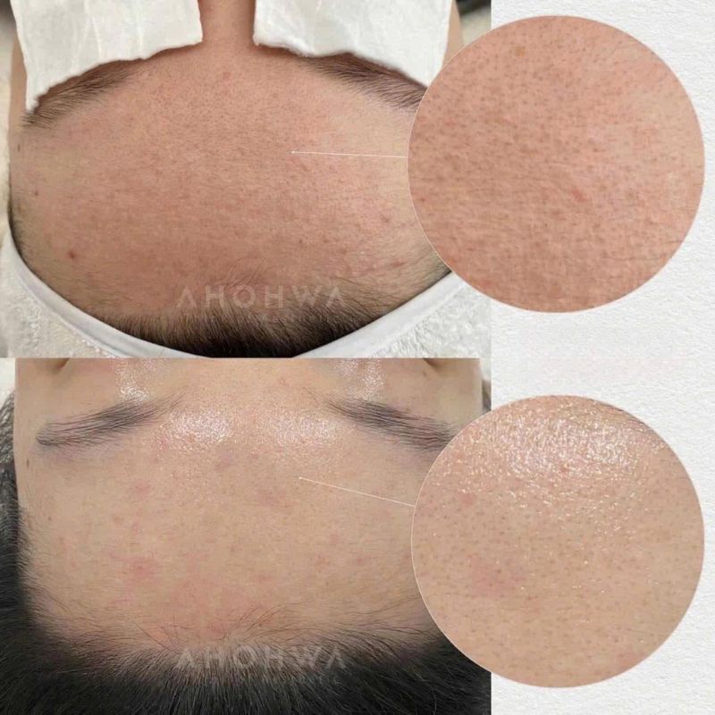 Kết quả sau khi dùng BHA Ahohwa